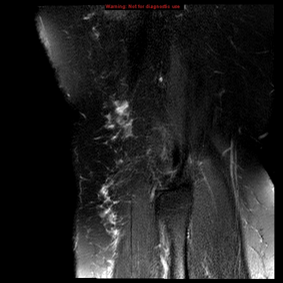 File:Anterior cruciate ligament tear (Radiopaedia 12329-12612 E 1).jpg
