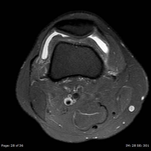 File:Anterior cruciate ligament tear (Radiopaedia 70783-80964 Axial PD fat sat 28).jpg