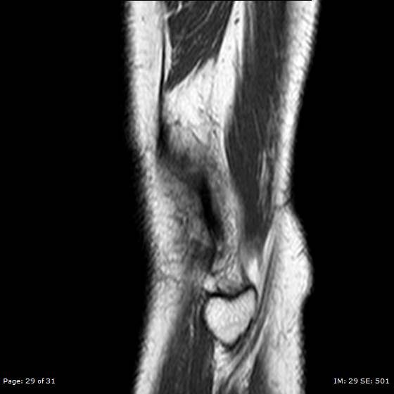 File:Anterior cruciate ligament tear (Radiopaedia 70783-80964 Sagittal T1 29).jpg