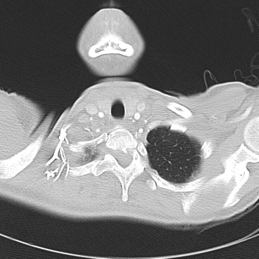 Anterior mediastinal lymphoma (Radiopaedia 29556-30061 Axial lung window 5).jpg