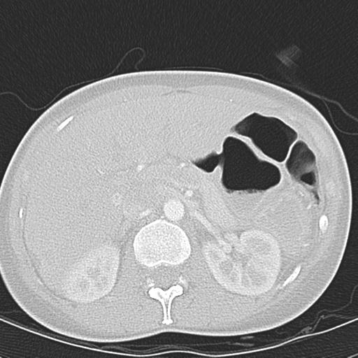 Anterior mediastinal lymphoma (Radiopaedia 29556-30061 Axial lung window 61).jpg