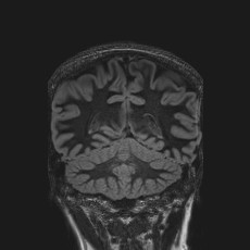 File:Anterior temporal encephalocele (Radiopaedia 82624-96808 Coronal FLAIR 37).jpg