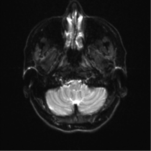 Anterior temporal lobe perivascular space (Radiopaedia 40946-43650 Axial DWI 3).png