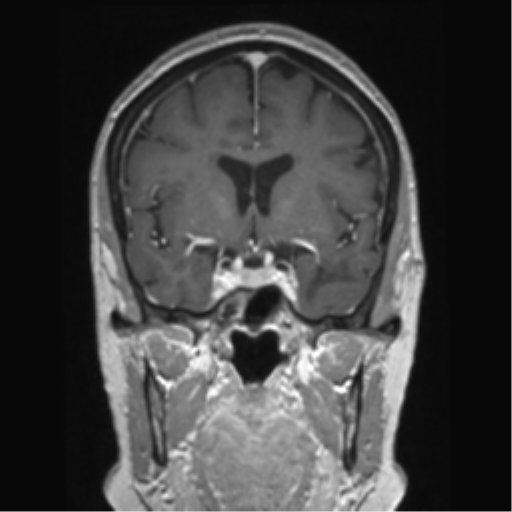 Anterior temporal pole cysts (Radiopaedia 46629-51102 Coronal T1 C+ 107).png