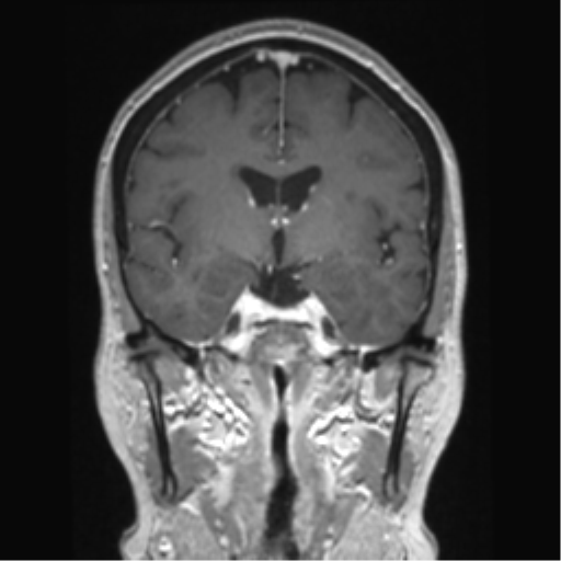 Anterior temporal pole cysts (Radiopaedia 46629-51102 Coronal T1 C+ 96).png