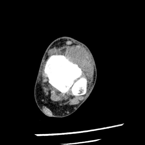 Anterior tibial artery false aneurysm (Radiopaedia 88984-105809 A 110).jpg