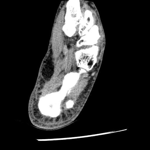 Anterior tibial artery false aneurysm (Radiopaedia 88984-105809 A 208).jpg