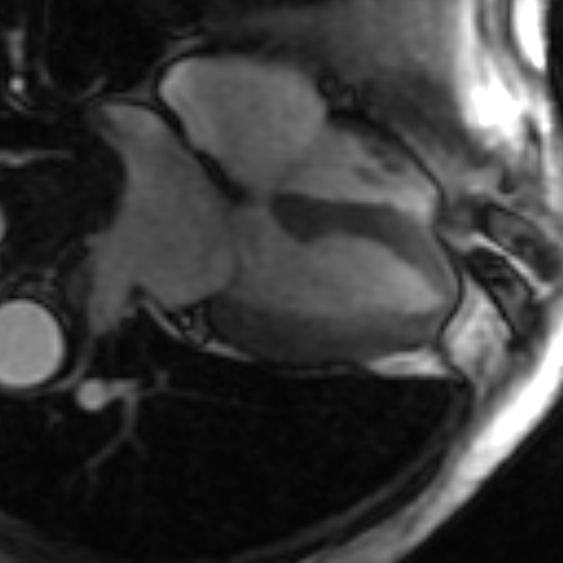 File:Anteroseptal hypokinesia after myocardial infarction (Radiopaedia 15978-15633 4 chamber view SSFE 8).jpg