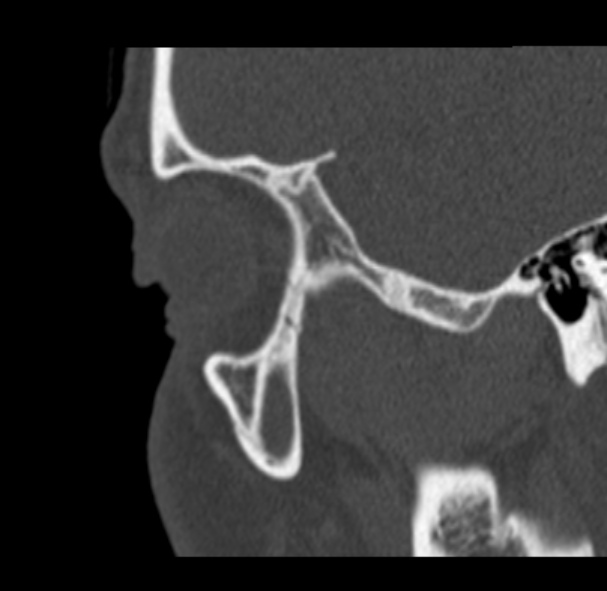 File:Antrochoanal polyp (Radiopaedia 33984-35202 Sagittal bone window 5).jpg