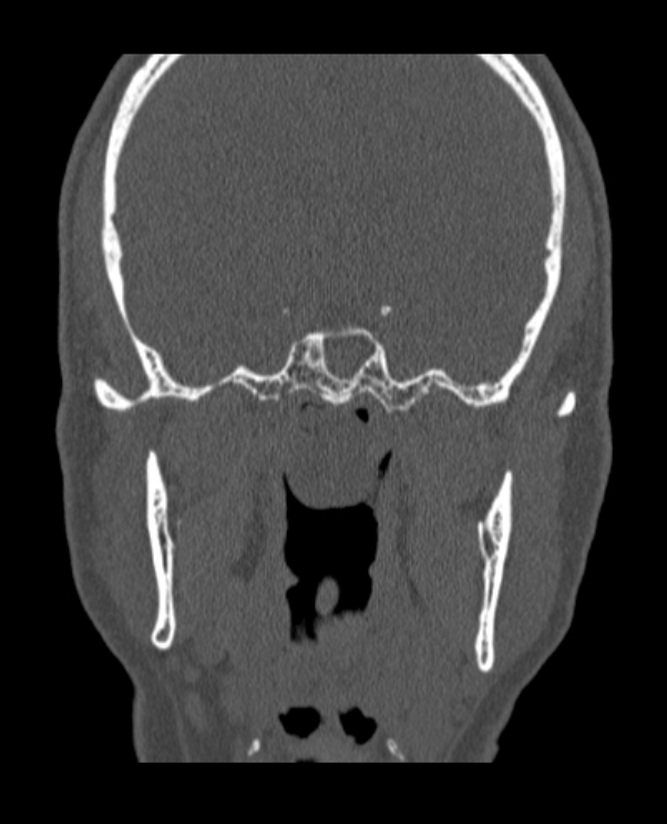 Antrochoanal polyp (Radiopaedia 79011-92169 Coronal bone window 14).jpg