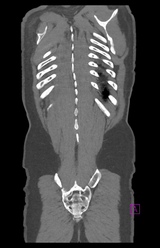 Aortectomy and axillary-bifemoral bypass (Radiopaedia 28303-28545 C 83).jpg