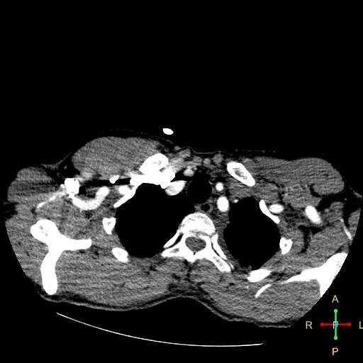File:Aortic aneurysm and penetrating ulcer (Radiopaedia 23590-23704 A 3).jpg