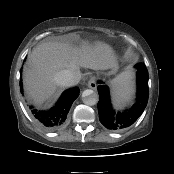 Aortic arch graft infection (FDG PET-CT) (Radiopaedia 71975-82437 A 53).jpg