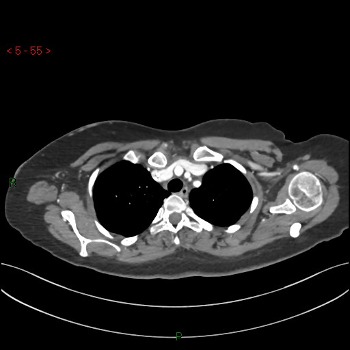 Aortic arch origin of left vertebral artery (Radiopaedia 51520-57286 A 54).jpg