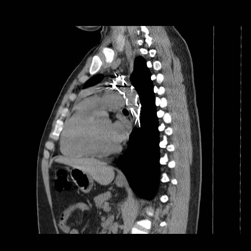 File:Aortic arch stent (Radiopaedia 30030-30595 B 16).jpg