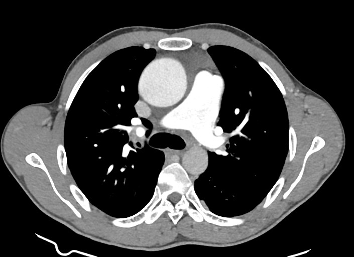 File:Aortic coarctation with aneurysm (Radiopaedia 74818-85828 A 129).jpg