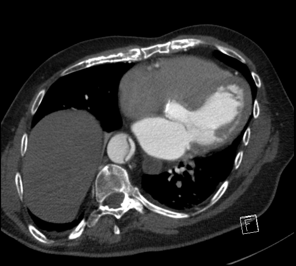 File:Aortic dissection (CTPA) (Radiopaedia 75506-86750 A 62).jpg