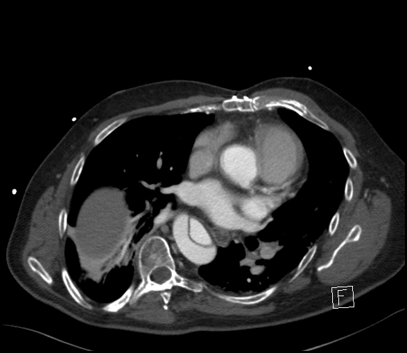 Aortic dissection (CTPA) (Radiopaedia 75506-86750 E 5).jpg