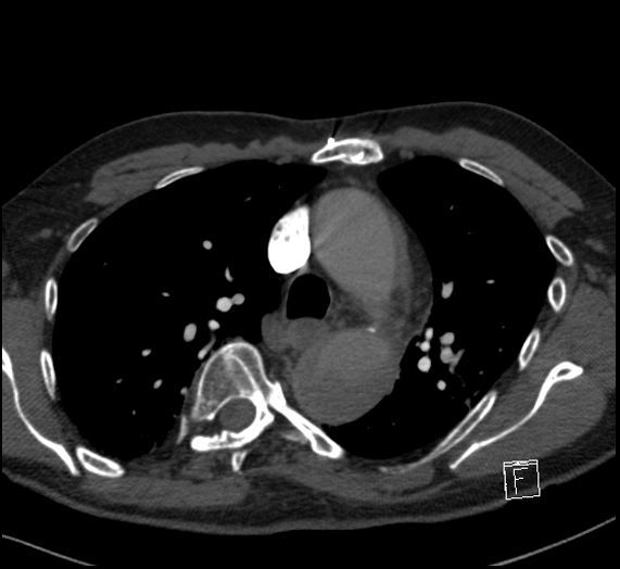 File:Aortic dissection (CTPA) (Radiopaedia 75506-86751 Axial C+ CTPA 49).jpg