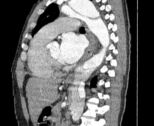 File:Aortic dissection - Stanford A -DeBakey I (Radiopaedia 28339-28587 C 42).jpg