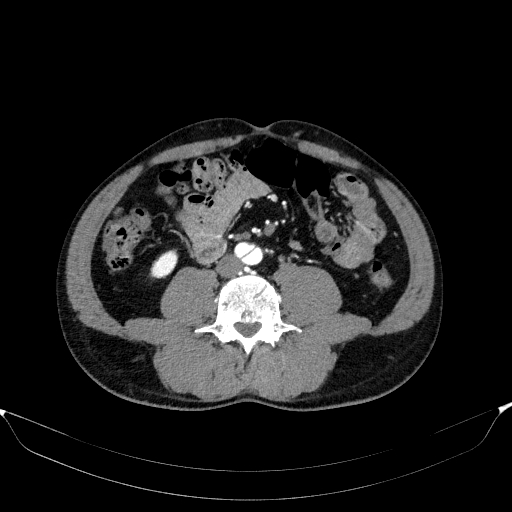 Aortic dissection - Stanford type A (Radiopaedia 83418-98500 A 87).jpg
