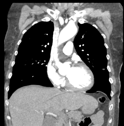 Aortic dissection - Stanford type B (Radiopaedia 50171-55512 B 34).png
