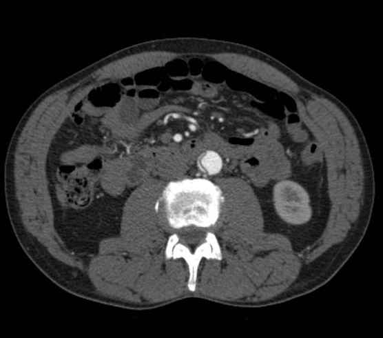 Aortic dissection - Stanford type B (Radiopaedia 73648-84437 A 165).jpg