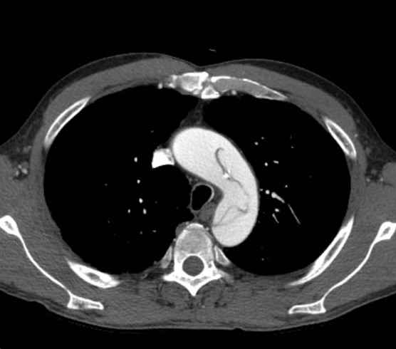 Aortic dissection - Stanford type B (Radiopaedia 73648-84437 A 22).jpg