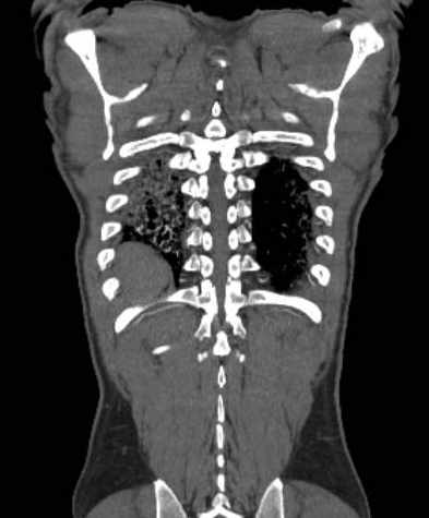 File:Aortic dissection - Stanford type B (Radiopaedia 73648-84437 B 104).jpg