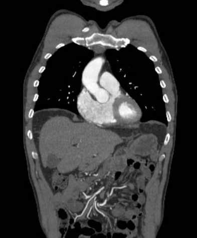 File:Aortic dissection - Stanford type B (Radiopaedia 73648-84437 B 37).jpg
