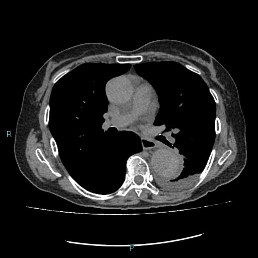 File:Aortic dissection extended to lusory artery (Radiopaedia 43686-47136 Axial non-contrast 14).jpg
