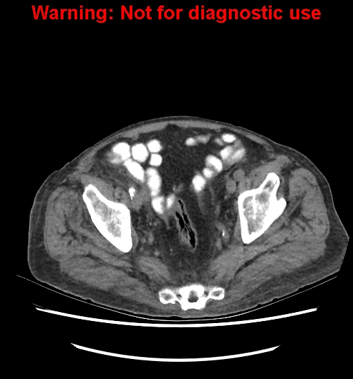 File:Aortic graft infection (Radiopaedia 44979-48907 Axial non-contrast 81).jpg