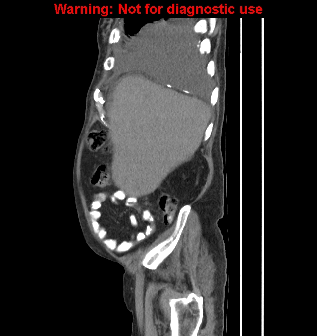 Aortic graft infection (Radiopaedia 44979-48907 C 57).jpg