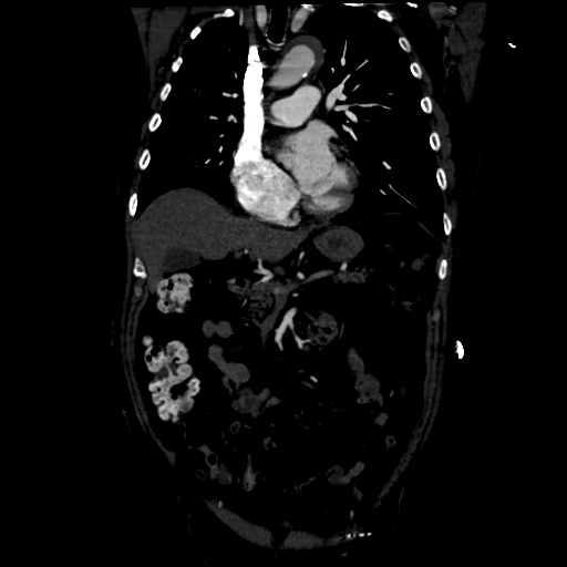 Aortic intramural hematoma (Radiopaedia 34260-35540 C 36).png