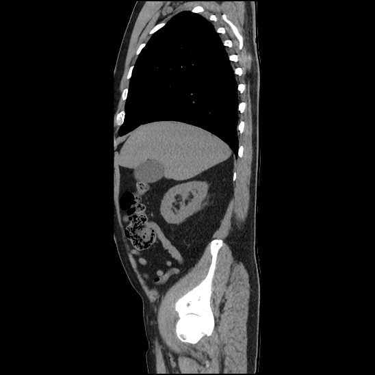 Aortic intramural hematoma (type B) (Radiopaedia 79323-92387 G 7).jpg