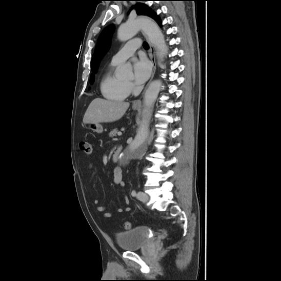 Aortic intramural hematoma (type B) (Radiopaedia 79323-92387 Sagittal C+ delayed 29).jpg