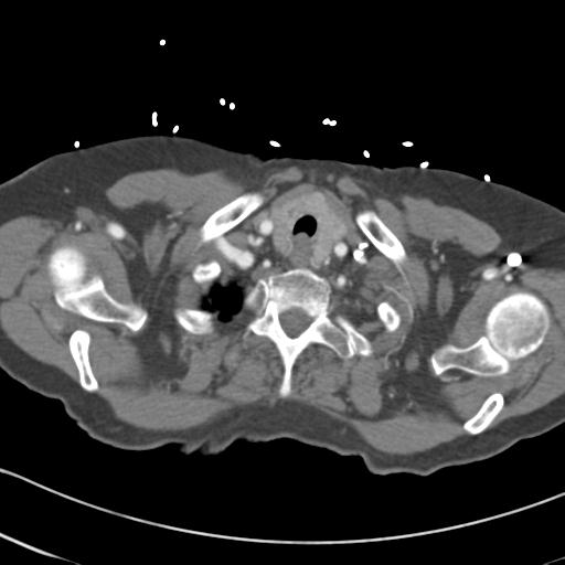 Aortic intramural hematoma from penetrating atherosclerotic ulcer (Radiopaedia 31137-31836 A 3).jpg