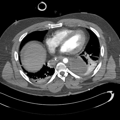 Aortic transection, diaphragmatic rupture and hemoperitoneum in a complex multitrauma patient (Radiopaedia 31701-32622 A 57).jpg