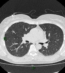 File:Aortic valve endocarditis (Radiopaedia 87209-103485 Axial lung window 48).jpg
