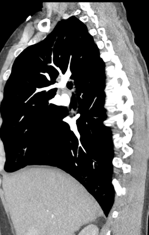 Aortic valve non-coronary cusp thrombus (Radiopaedia 55661-62189 C+ arterial phase 42).png