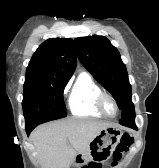 File:Aortic valve non-coronary cusp thrombus (Radiopaedia 55661-62189 C 19).png