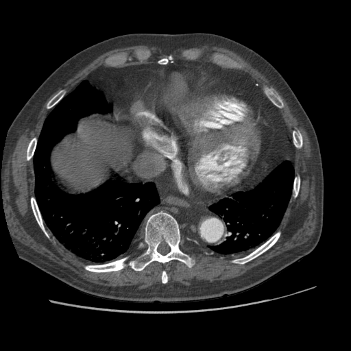 File:Aorto-coronary bypass graft aneurysms (Radiopaedia 40562-43157 A 92).png