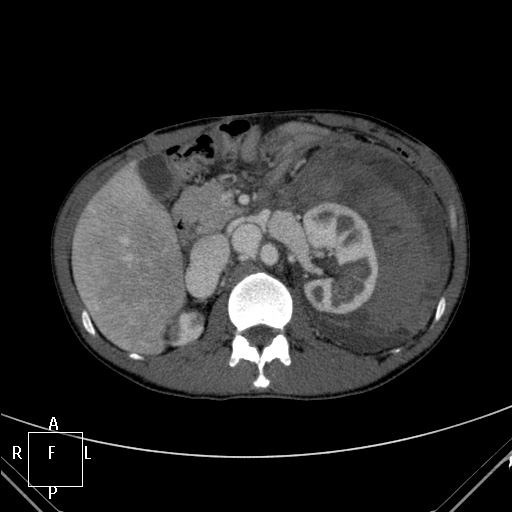 File:Aorto-left renal vein fistula (Radiopaedia 45534-49628 A 18).jpg