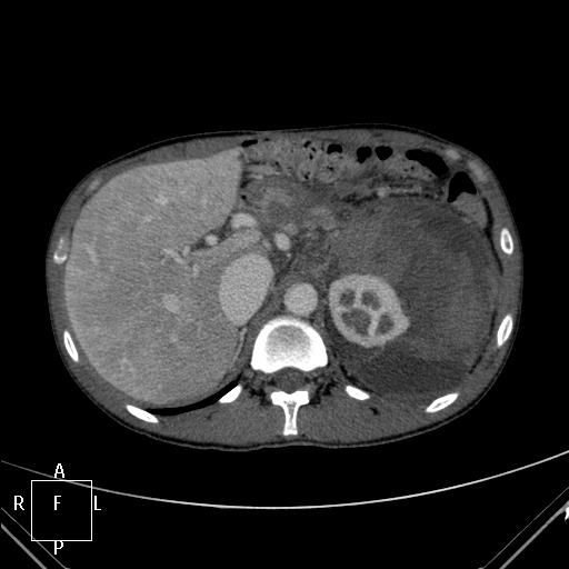 File:Aorto-left renal vein fistula (Radiopaedia 45534-49628 A 5).jpg
