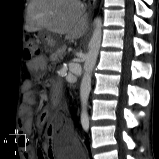 Aorto-left renal vein fistula (Radiopaedia 45534-49628 C 35).jpg