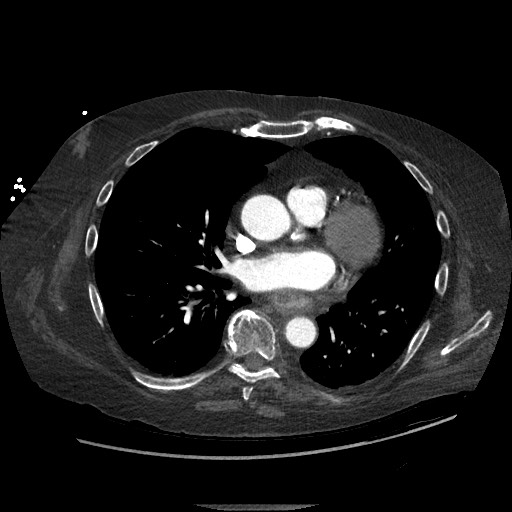 Aortoesophageal fistula with endovascular repair (Radiopaedia 73781-84592 Axial C+ CTPA 88).jpg