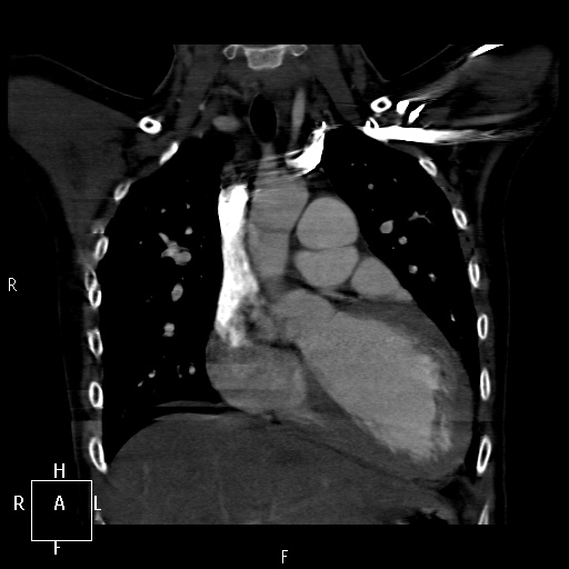 File:Aortopulmonary septal defect (Radiopaedia 41990-45013 Coronal C+ CTPA 21).jpg