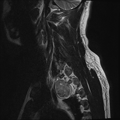 File:Apical lung mass mimic - neurogenic tumor (Radiopaedia 59918-67394 Sagittal T2 18).jpg