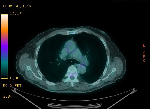 Appendiceal adenocarcinoma complicated by retroperitoneal abscess (Radiopaedia 58007-65041 Axial PET-CT 62).jpg