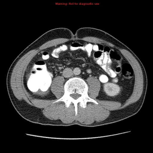 Appendicitis and renal cell carcinoma (Radiopaedia 17063-16760 A 33).jpg